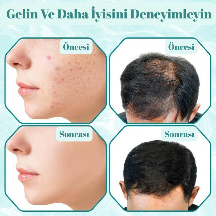 Yüksek Frekans Cilt Bakım Cihazı